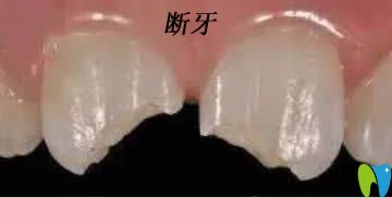 牙醫(yī)答疑:斷牙如何修復?牙齒斷了一半用樹脂修補還是美牙冠