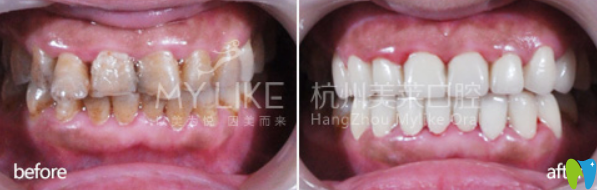 杭州美萊口腔明星全瓷牙修復(fù)牙齒案例前后效果對(duì)比