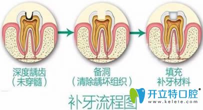 開立特口腔網(wǎng)兒童補(bǔ)牙有必要嗎