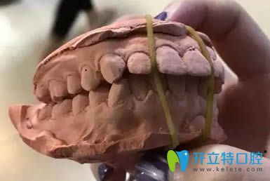 圍觀我花5萬多讓廈門賽德陽光洪慈憶做的齙牙矯正怎么樣？