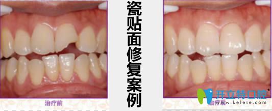 瓷貼面修復(fù)案例及前后對比效果