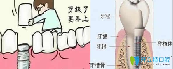 醫(yī)生告訴你為什么要做種植牙？種植牙哪里比假牙好？