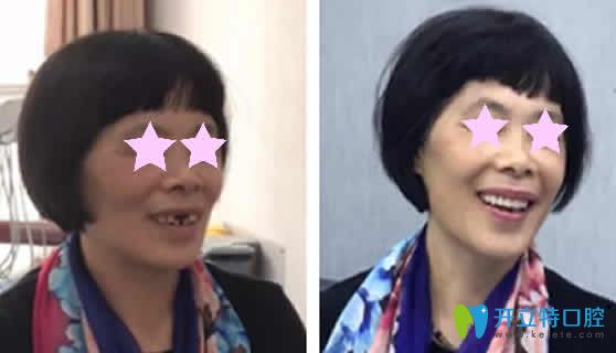 老媽在重慶華諾世口腔做種植牙前后對(duì)比照片