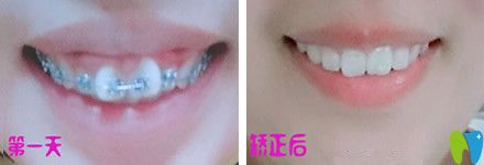 牙齒只有一兩顆不齊可以做半口矯正嗎？來看北京中諾口腔半口牙矯正真人案例