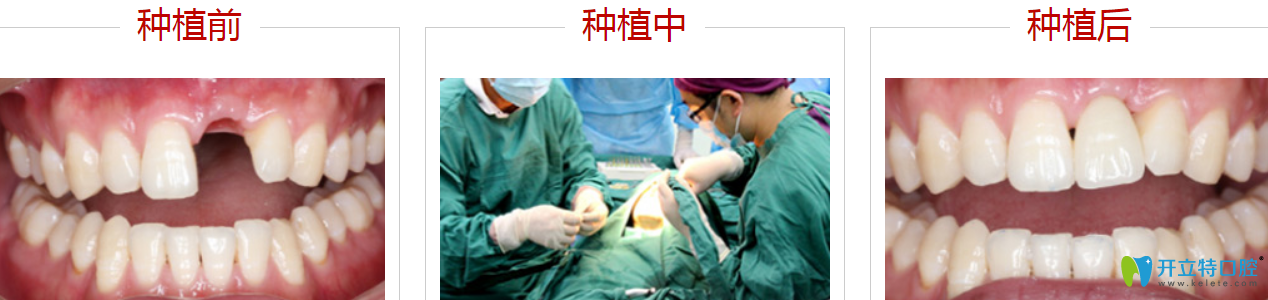 深圳哪里種牙比較好？來看格倫菲爾種植牙案例