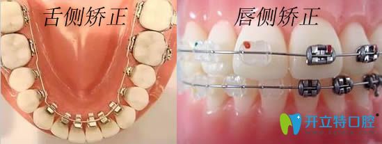 舌側(cè)矯正和唇側(cè)矯正對比圖片