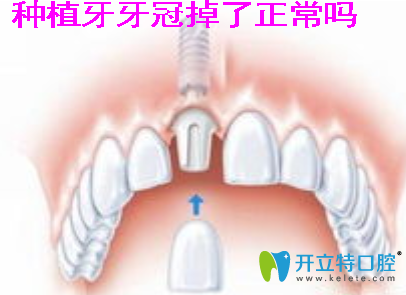 種植牙牙冠掉了正常嗎?看種植牙牙冠脫落的原因及如何修復