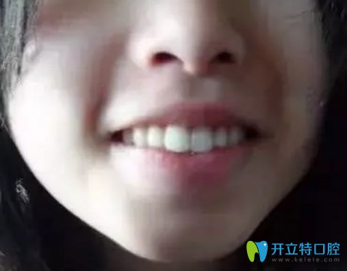 牙齒整齊但是嘴巴前凸矯正術(shù)前照