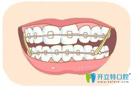 為什么牙齒矯正后容易長蛀牙?如何有效預防矯正中出現(xiàn)齲齒