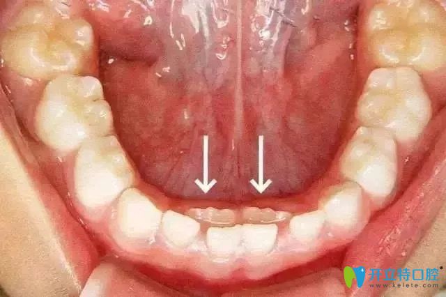 兒童長雙排牙怎么辦？孩子雙排牙國外都不拔是真的嗎？