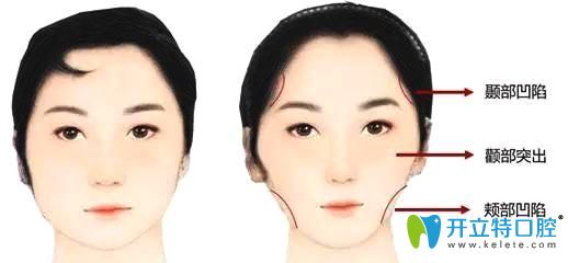 牙齒矯正中牙套臉是怎么形成的？什么臉型容易出現(xiàn)牙套臉