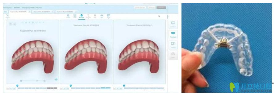  3D掃描后電腦上形成的3D模型及后期咬合微調(diào)階段牙套模型
