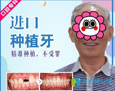 牙大夫與美奧口腔哪個好？美奧口腔種植牙案例來揭曉