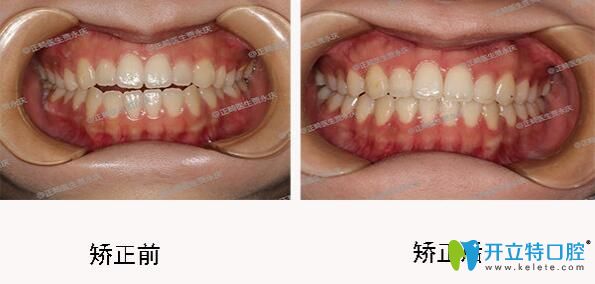 成都口腔哪里正畸好？圣貝口腔牙齒矯正效果來(lái)揭曉