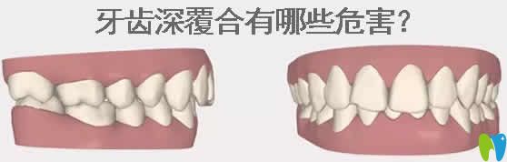 牙齒深覆合有哪些危害