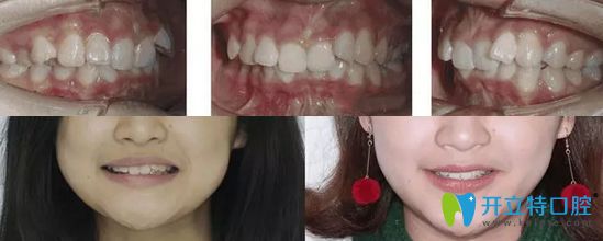 深覆合矯正前后對(duì)比照片