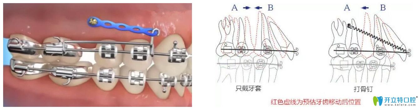 正畸打骨釘疼嗎？牙齒矯正拔骨釘疼不疼