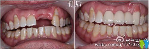 深圳韋博口腔種植牙對比圖