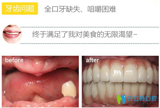 北極星種植牙前后對比圖