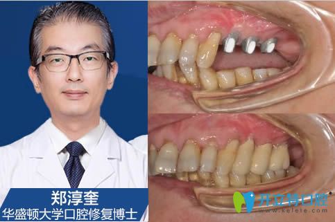 <!--<i data=20240703-sp></i>-->鄭淳奎種植牙案例效果對(duì)比圖