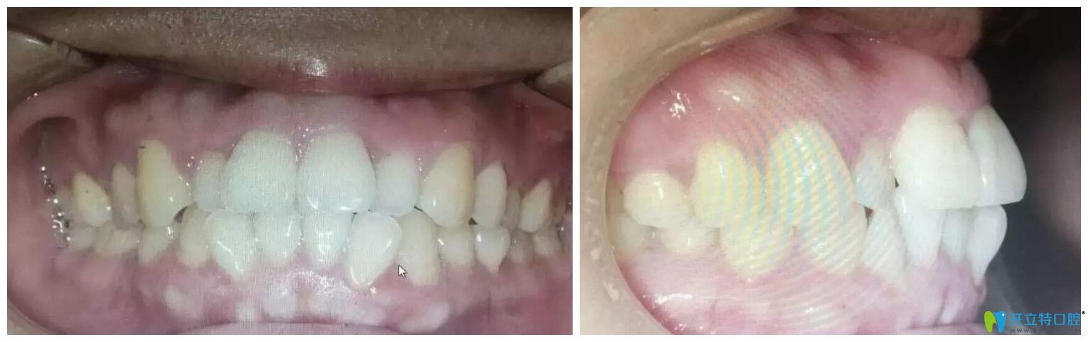 找趙中華做牙齒矯正前口腔正面、側面照