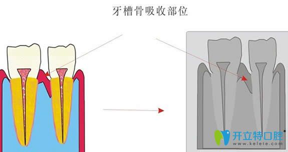 牙槽骨缺失圖