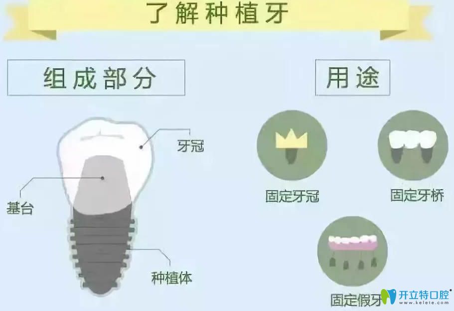 種植牙的組成部分和用途決定了它的收費價格