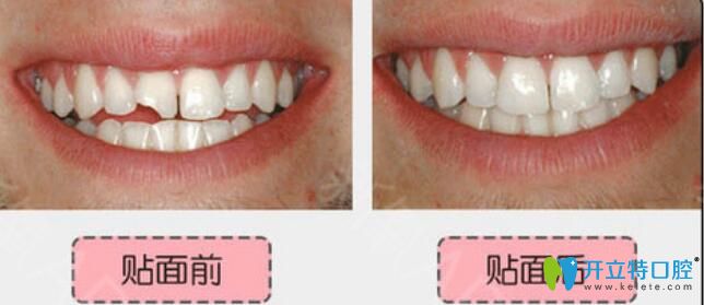 無錫北極星口腔楊亮亮怎么樣？真人案例及反饋來驗證