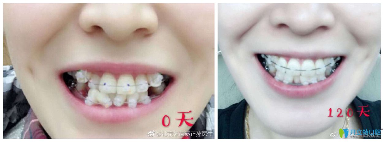 北京中諾口腔劉興華正畸怎么樣？案例效果來(lái)驗(yàn)證