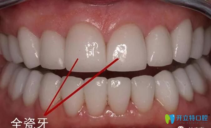 全瓷牙產(chǎn)地影響價(jià)格的，來(lái)看深圳進(jìn)口/國(guó)產(chǎn)全瓷牙多少錢一顆