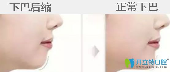下巴后縮帶牙套有用嗎？真相揭秘下巴后縮矯正后堪比整容