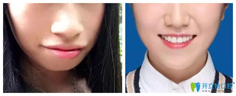 牙齒正畸對臉型的影響？看牙齒矯正案例效果前后對比圖