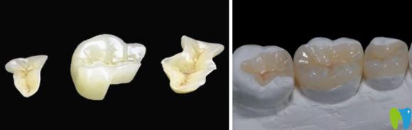 嵌體補牙3300貴不貴?透露同樣是補牙為什么嵌體要貴10倍以上