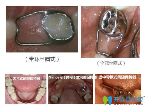 固定式保持器