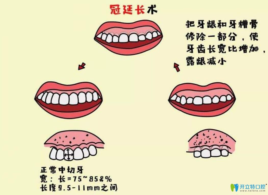 牙冠延長術(shù)是什么，有什么作用