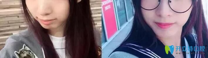 青島維樂口腔梁騰怎么樣？牙齒矯正案例效果來(lái)揭曉