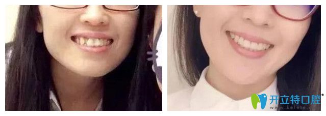 青島維樂(lè)口腔<!--<i data=20240703-sp></i>-->牙齒矯正怎么樣？案例效果來(lái)驗(yàn)證