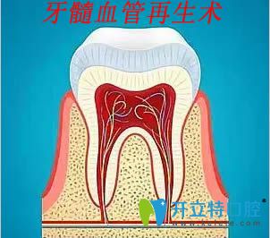 何為牙髓血管再生術(shù)?年輕恒牙血管再生的適應(yīng)癥和優(yōu)勢(shì)介紹