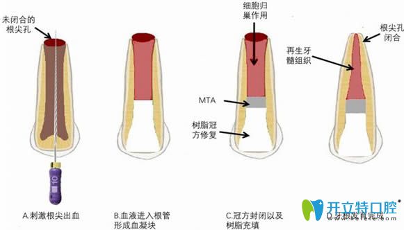 牙髓血管再生術(shù)治療過(guò)程圖解