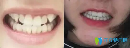 牙齒矯正前后對比圖