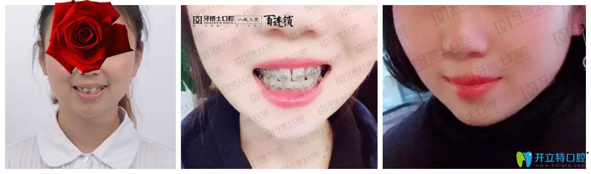 重慶成佳牙博士怎么樣，坑人嗎？看牙博士口腔醫(yī)生矯正真人案例
