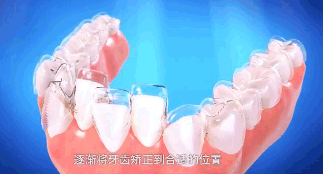 重慶成佳牙博士好不好呢，牙齒矯正效果來預(yù)見