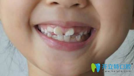 小孩新?lián)Q的恒牙長歪了怎么辦?恒牙長歪會自動調(diào)整歸位嗎?