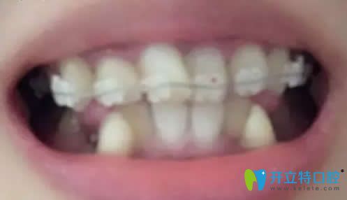 我在北京京通口腔做陶瓷托槽牙齒矯正第1個(gè)月