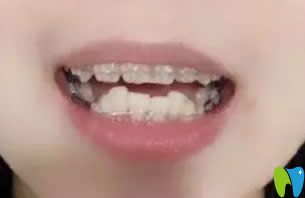 我在北京京通口腔做牙齒矯正第6個(gè)月