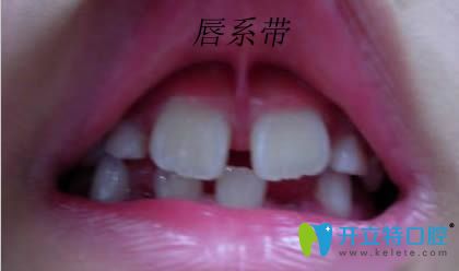 上唇系帶修整術是什么？唇系帶斷了修復時間是何時