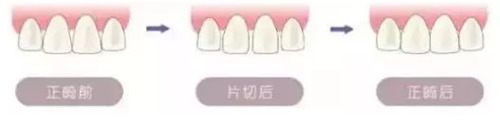 做的片切正畸后悔死了：深究牙齒片切矯正的危害有哪些？