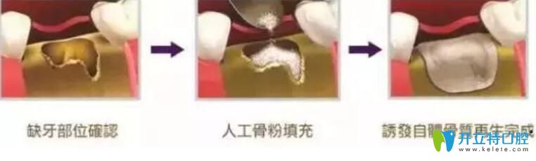 骨粉是個(gè)什么東西？為什么種牙要植骨粉
