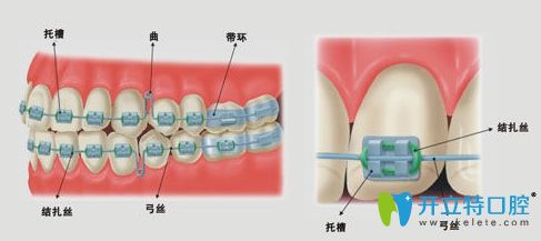 牙齒托槽掉了必須要馬上粘接