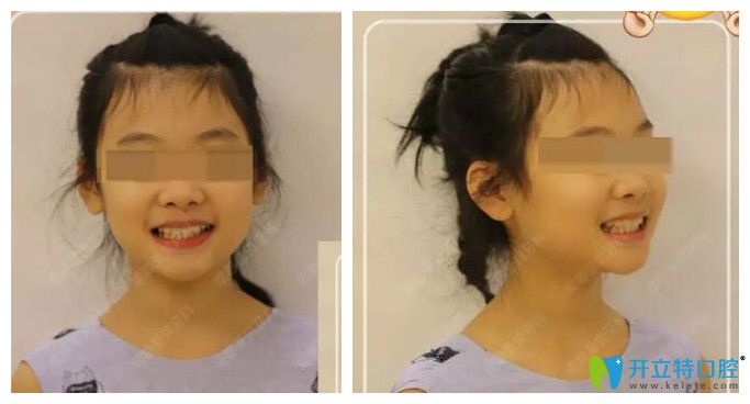 小孩子在成都圣貝口腔矯正后效果圖